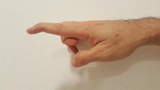 תיאור מקרה: Mallet Finger – מאלט פינגר (אצבע פטיש)