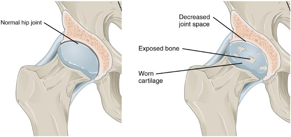 אוסטאוארטריטיס, דלקת מפרקים ניוונית - Oateoarthritis בירך