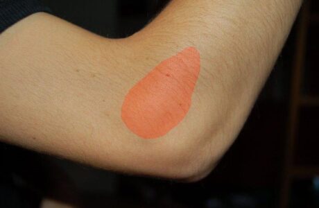 מרפק טניס (Tennis Elbow) – כל מה שחשוב לדעת