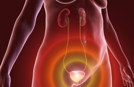 שלפוחית רגיזה