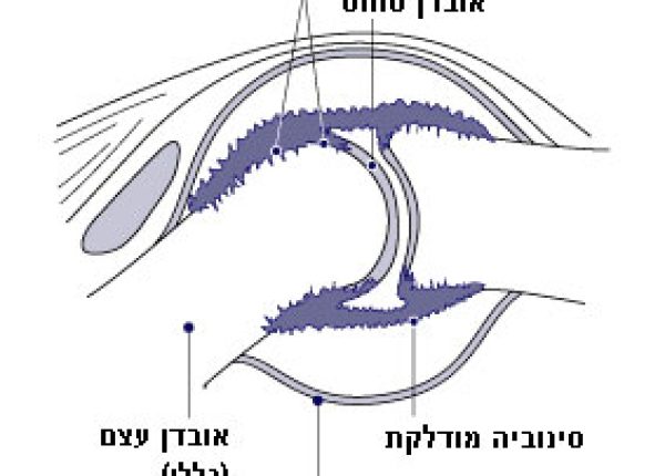 דלקת מפרקים שגרונית – Rheumatoid Arthritis